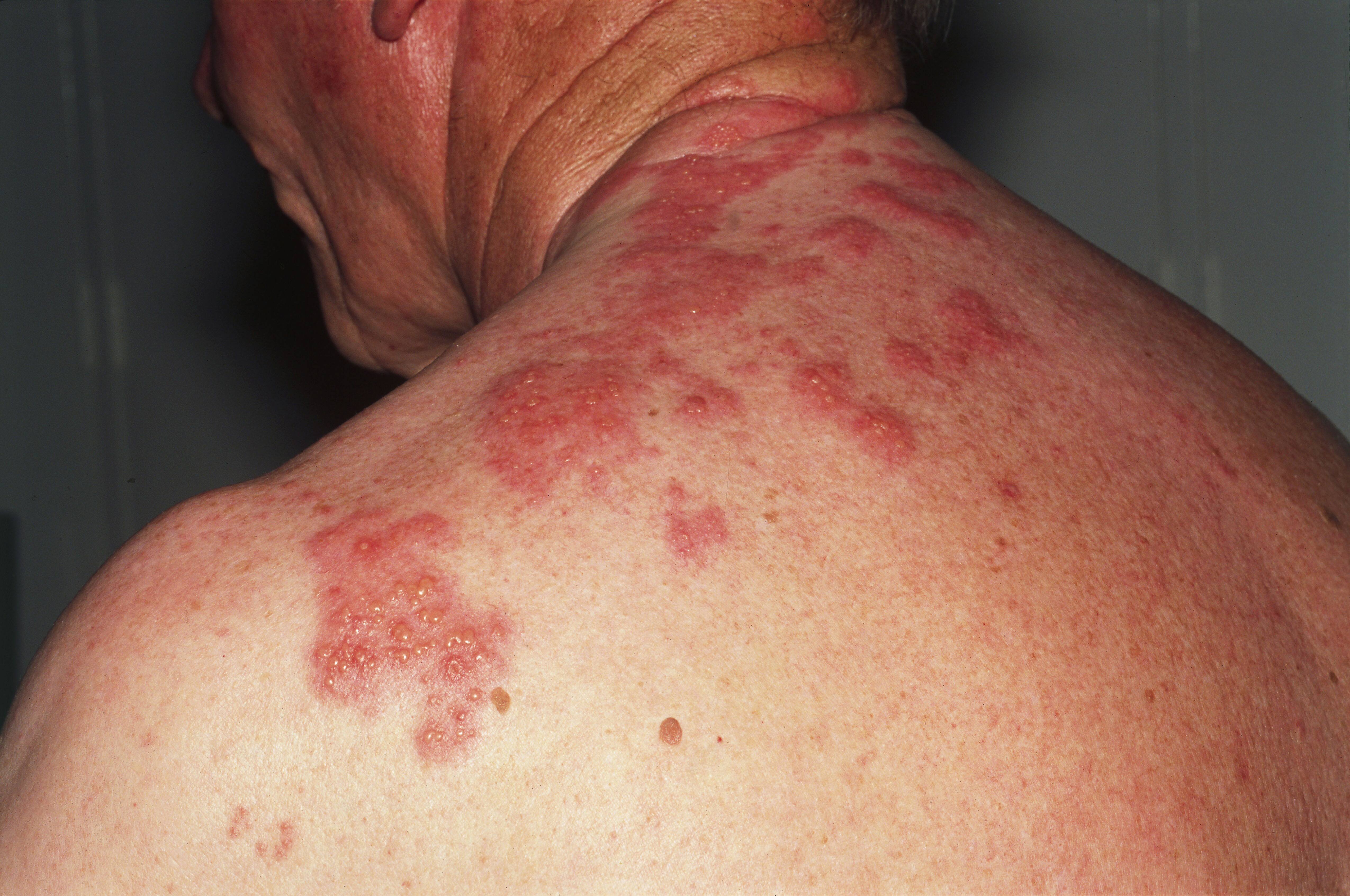 Shingrix Shingles Vaccine